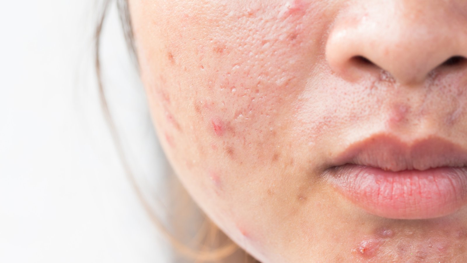 7 mythes sur l'acné auxquels vous devez cesser de croire!