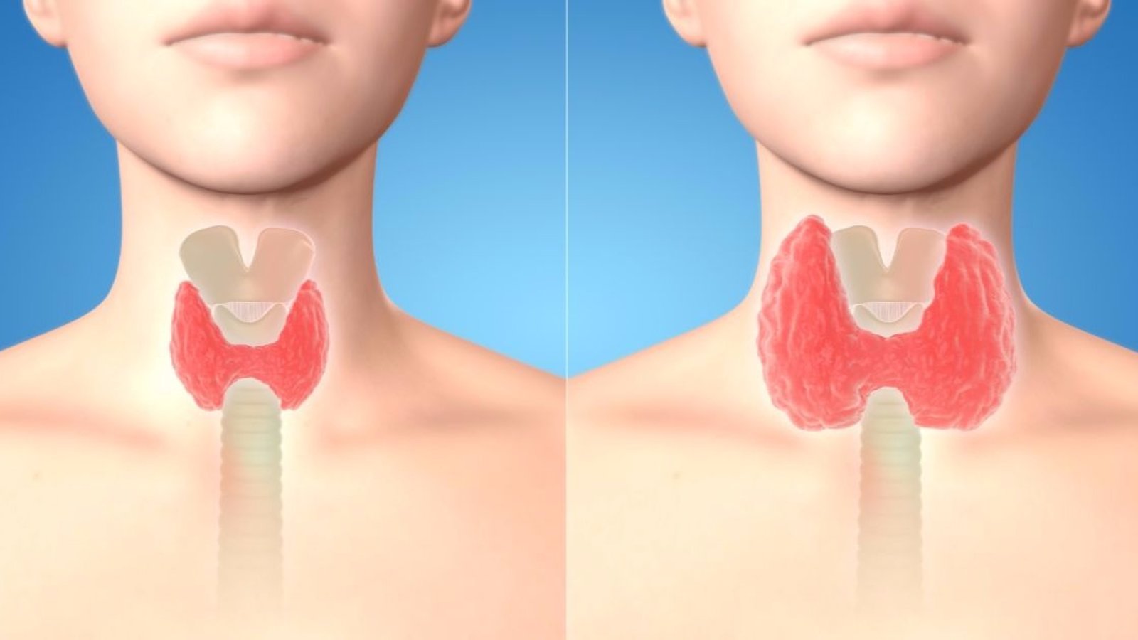 Sauriez-vous reconnaitre ces 10 symptômes d’un problème de glande thyroïde?