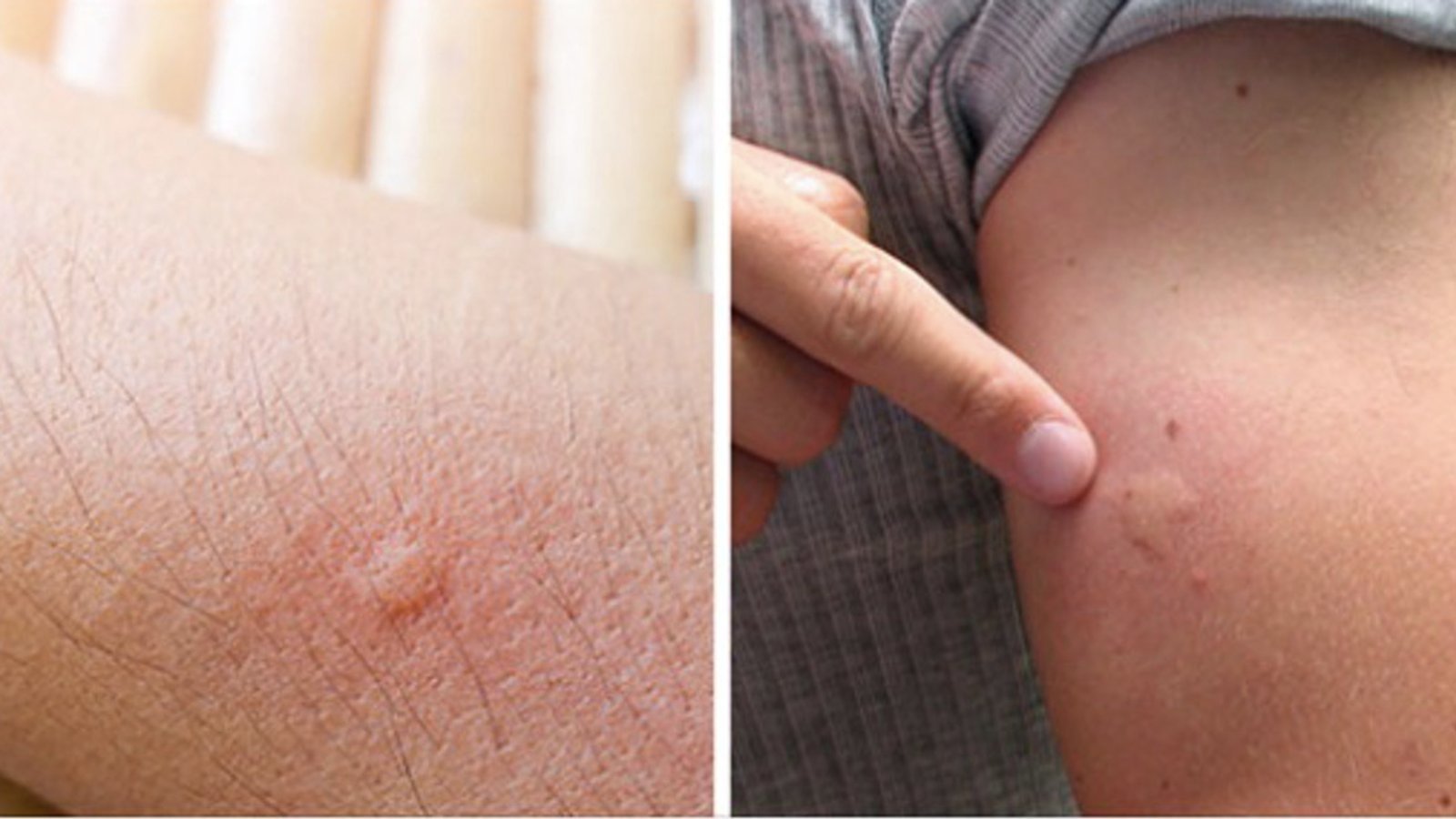 7 raisons pour lesquelles certaines personnes se font plus piquer par les moustiques que d'autres 
