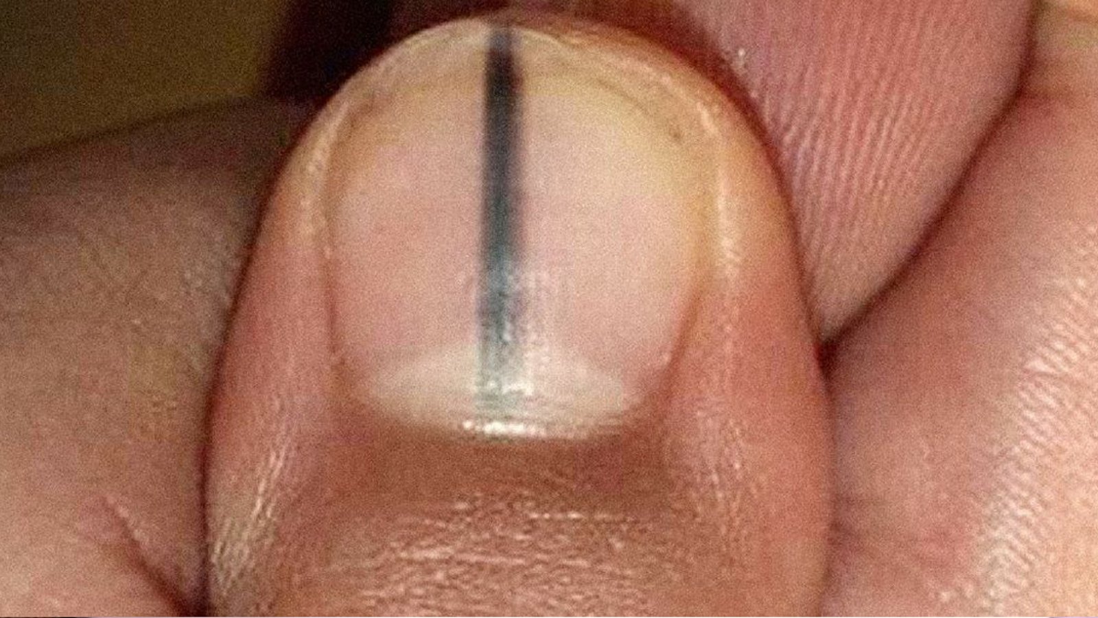 Vous voyez une ligne noire sur votre ongle? Consultez immédiatement votre médecin