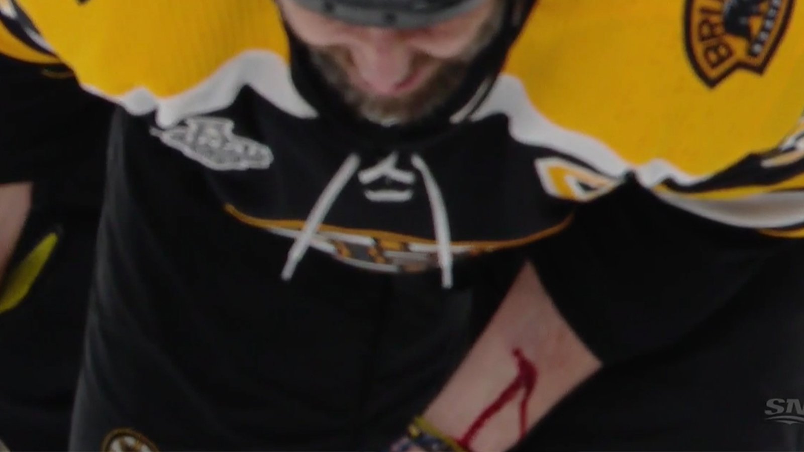 Chara gets cut open, leaves Game 1 in the final seconds